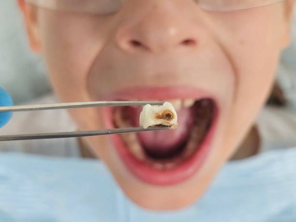 Best Emergency Tooth Extraction in Sublette, KS